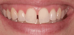 Dental Implants Veneers Appleton Fox Valley Green Bay Neenah
